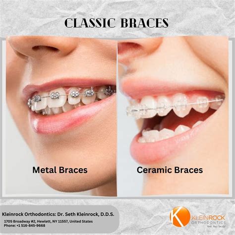 sticker metal bracket braces|Understanding the Advantages: A Detailed Look at.